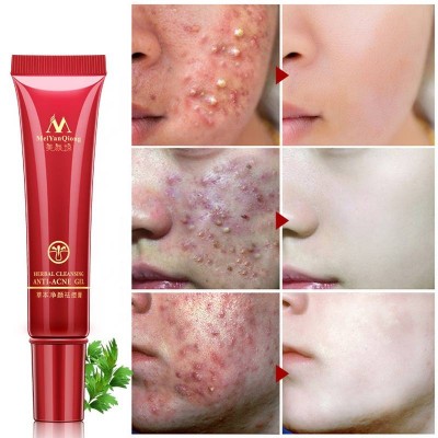 Meiyanqiong Acne Scar Removal Cream Skin Repair Stretch Marks Whitening Cream